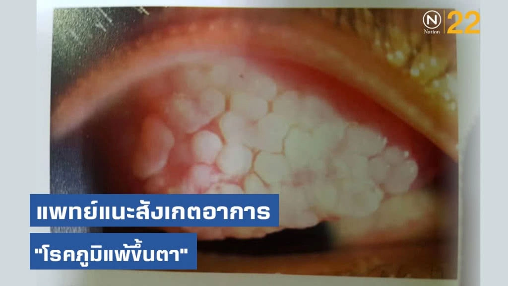 แพทย์แนะสังเกตอาการ "โรคภูมิแพ้ขึ้นตา"