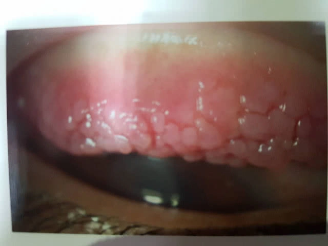 แพทย์แนะสังเกตอาการ "โรคภูมิแพ้ขึ้นตา"