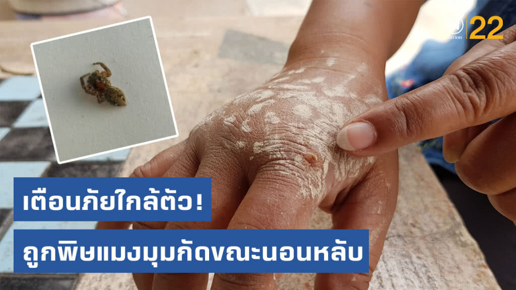 เตือนภัยใกล้ตัว! สาวใหญ่ถูกพิษแมงมุมกัดขณะนอนหลับ อาการน่าเป็นห่วง