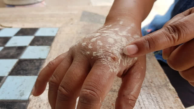 เตือนภัยใกล้ตัว! สาวใหญ่ถูกพิษแมงมุมกัดขณะนอนหลับ อาการน่าเป็นห่วง