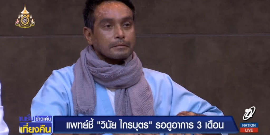 หมอเผยอาการ "วินัย ไกรบุตร" ต้องดูอาการ 3 เดือน ชี้โรคนี้กลับมาเป็นซ้ำได้