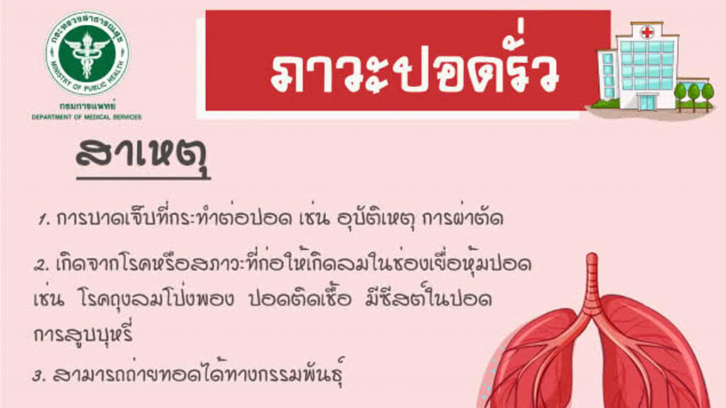 กรมการแพทย์ เตือนผู้ที่มีภาวะลมในช่องเยื่อหุ้มปอด ปล่อยไว้อันตรายถึงชีวิต