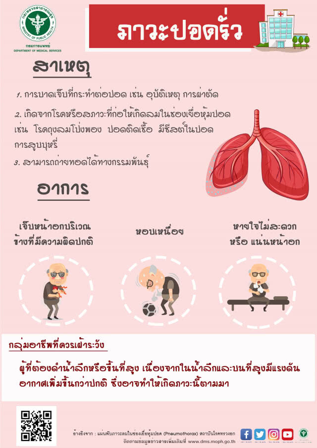 กรมการแพทย์ เตือนผู้ที่มีภาวะลมในช่องเยื่อหุ้มปอด ปล่อยไว้อันตรายถึงชีวิต