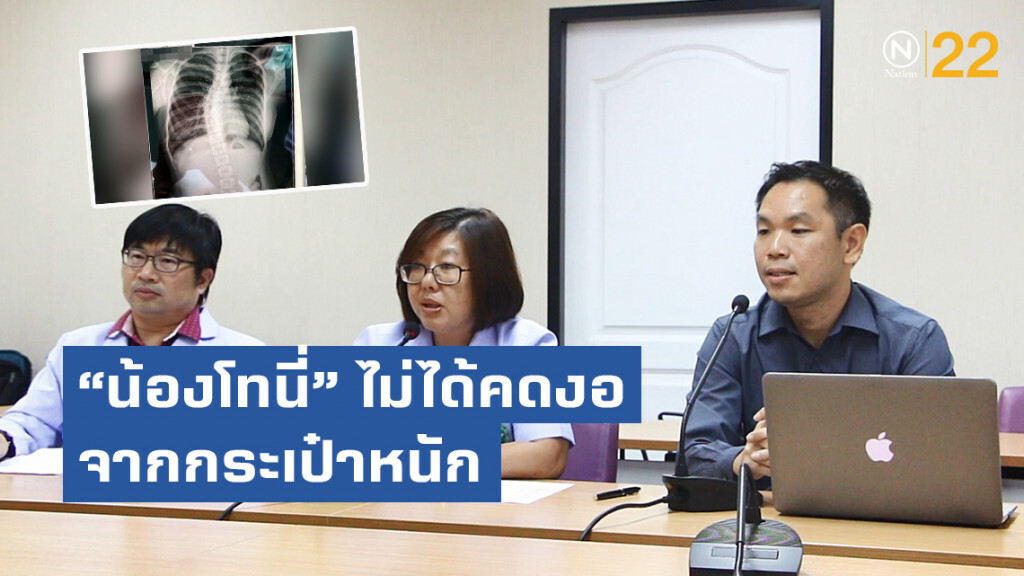 เผยผลตรวจกระดูกสันหลัง "น้องโทนี่" ไม่ได้คดงอจากกระเป๋าหนัก
