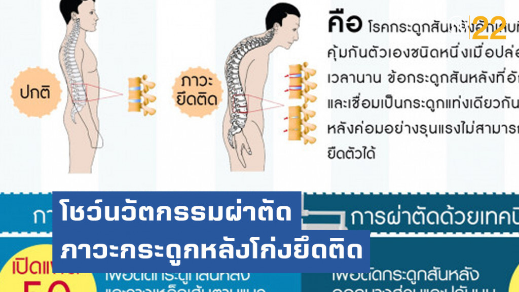 รพ.ราชวิถี โชว์นวัตกรรมผ่าตัดภาวะกระดูกหลังโก่งยึดติด ด้วยเทคนิคแผลเล็ก