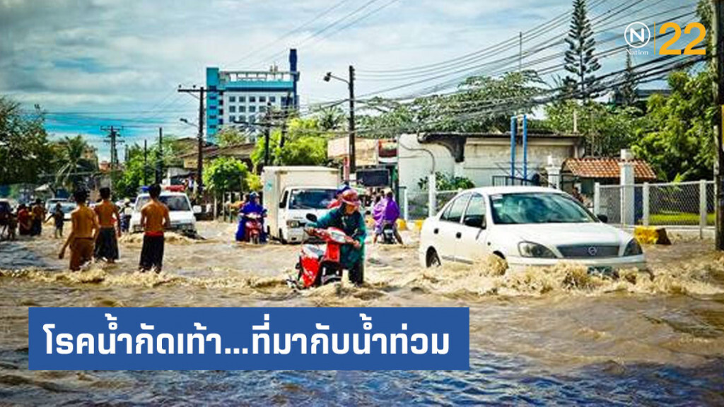 โรคน้ำกัดเท้า...ที่มากับน้ำท่วม