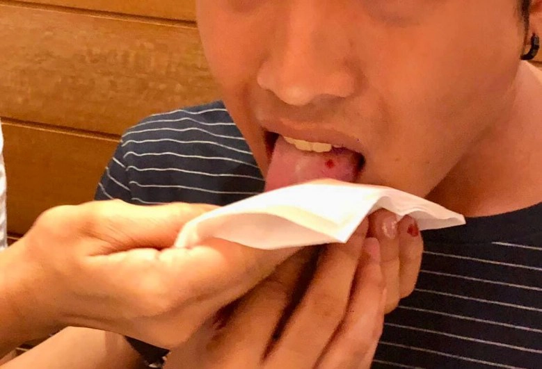 โพสต์เตือน! เศษแก้วปนในอาหารร้านดัง แทงลิ้น