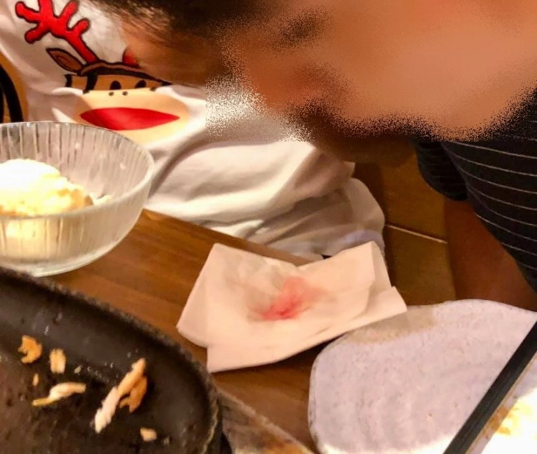 โพสต์เตือน! เศษแก้วปนในอาหารร้านดัง แทงลิ้น