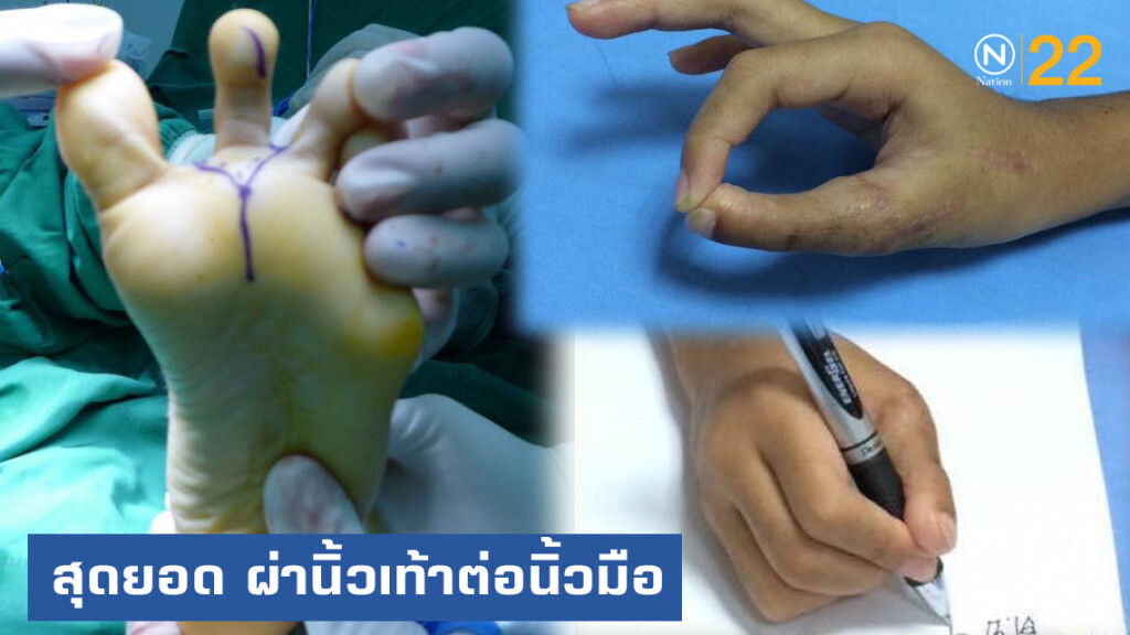 หมอไทยสุดยอด ผ่าตัดต่อนิ้วมือเด็ก 7 ขวบด้วยนิ้วเท้า