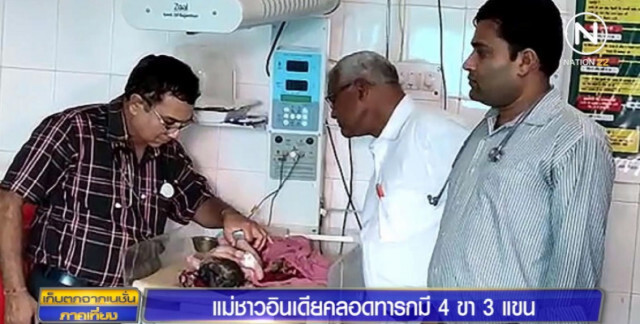 แม่ชาวอินเดียคลอดลูก 4 ขา 3 แขน เชื่อน่าจะเชื่อมกับแฝดอีกคน