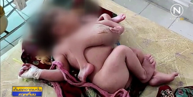 แม่ชาวอินเดียคลอดลูก 4 ขา 3 แขน เชื่อน่าจะเชื่อมกับแฝดอีกคน