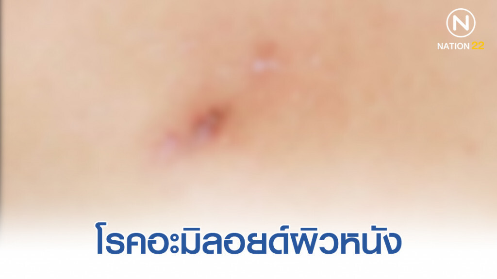 โรคอะมิลอยด์ผิวหนัง ที่ควรรู้