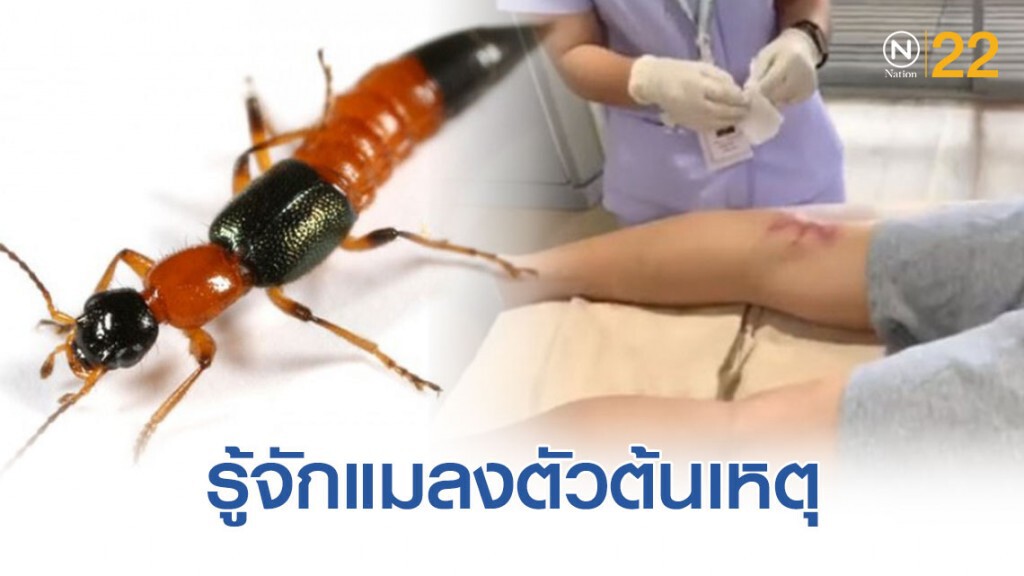 มาทำความรู้จักแมลงตัวต้นเหตุ "ด้วง(แมลง)ก้นกระดก" มาทำความรู้จักแมลงตัวต้นเหตุ "ด้วง(แมลง)ก้นกระดก"