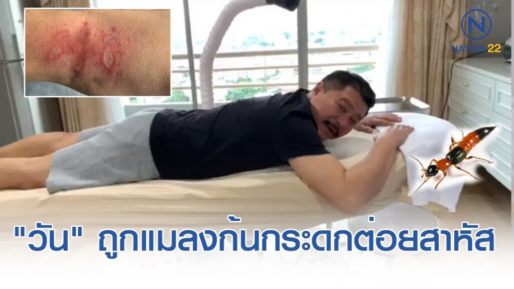 "วัน อยู่บำรุง" เผยอาการ หลังถูกด้วง(แมลง)ก้นกระดกต่อยสาหัส