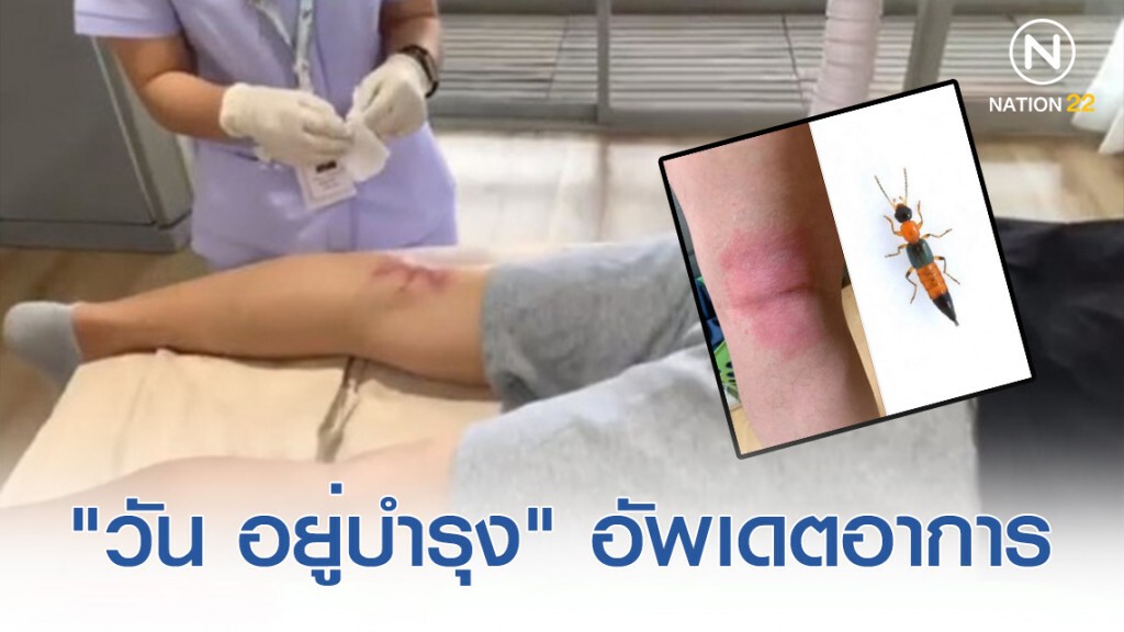 "วัน อยู่บำรุง" อัพเดตอาการ หลังถูกด้วง(แมลง)ก้นกระดกต่อยสาหัส "วัน อยู่บำรุง" อัพเดตอาการ หลังถูกด้วง(แมลง)ก้นกระดกต่อยสาหัส