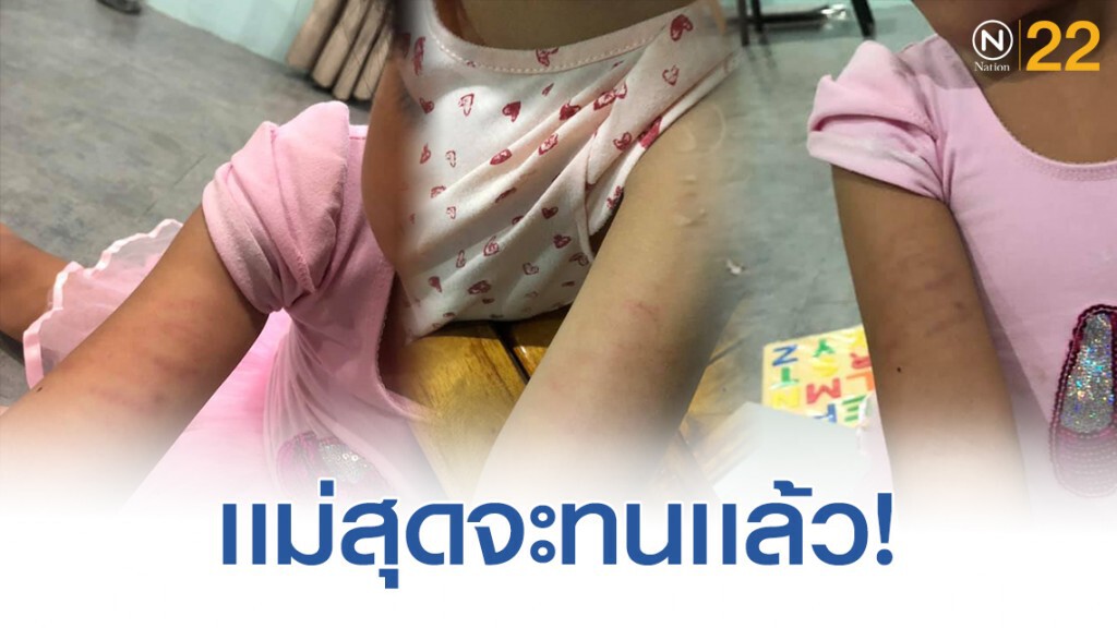 เเม่โพสต์! ครูโหดตีลูกตนจนช้ำ เหตุเพราะตอบคำถามครูไม่ได้