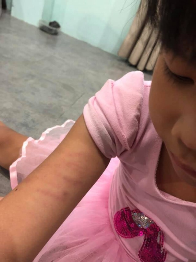 เเม่โพสต์! ครูโหดตีลูกตนจนช้ำ เหตุเพราะตอบคำถามครูไม่ได้