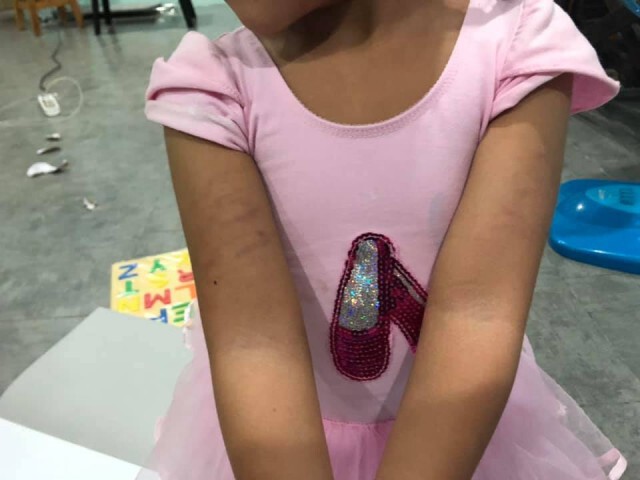 เเม่โพสต์! ครูโหดตีลูกตนจนช้ำ เหตุเพราะตอบคำถามครูไม่ได้