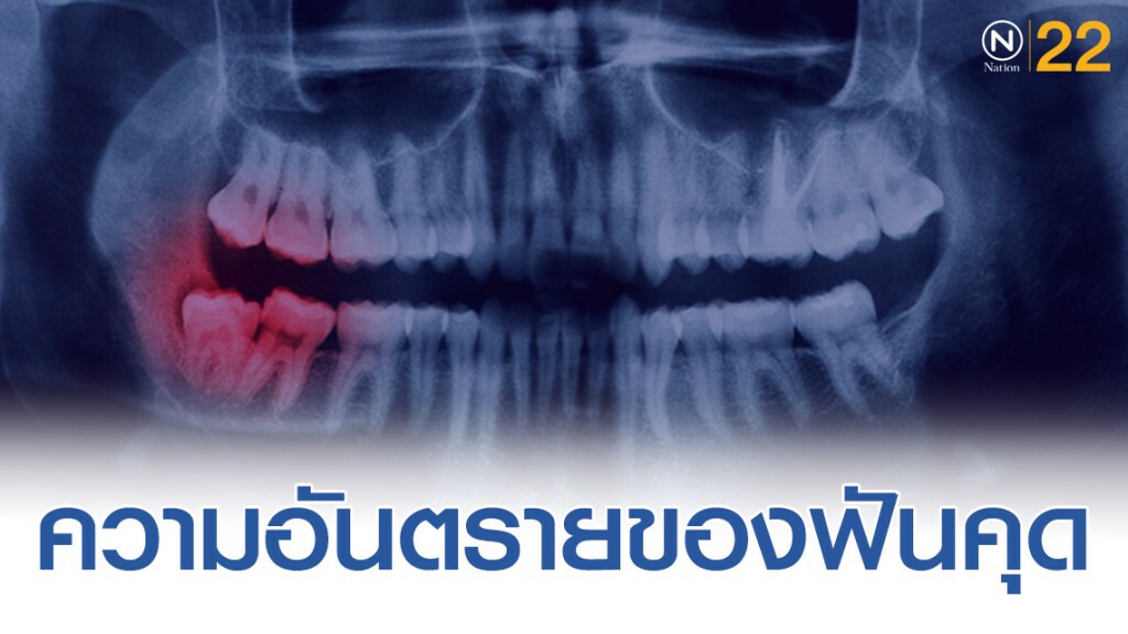 ความอันตรายของฟันคุด