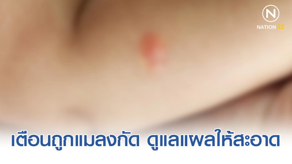 เตือนประชาชนถูกแมลงกัด ดูแลแผลให้สะอาด อาจเสี่ยงป่วยโรคเนื้อเน่าได้
