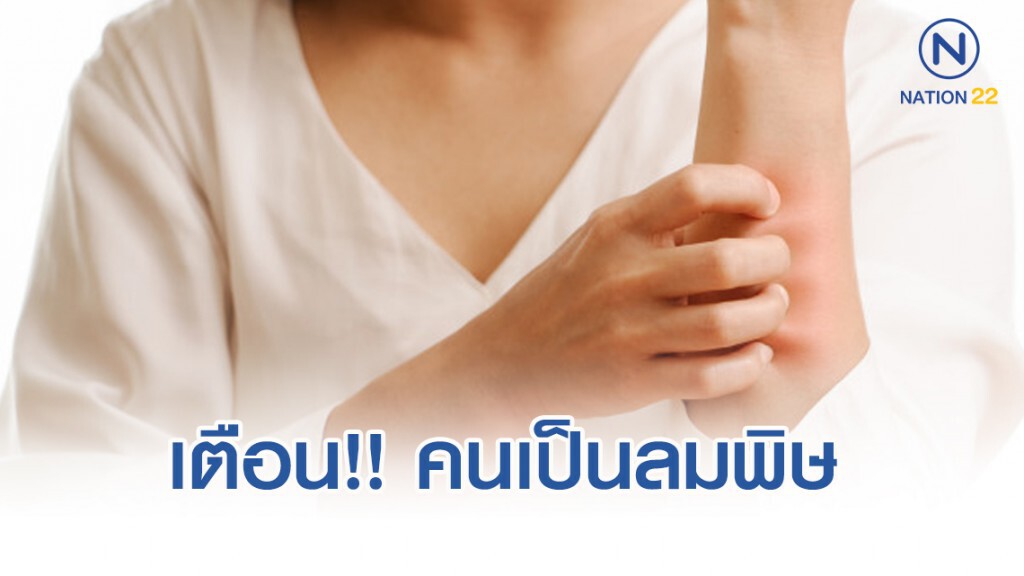 เตือน!! "โรคลมพิษ" รุนแรงถึงขั้นแน่นหน้าอก ต้องพบแพทย์