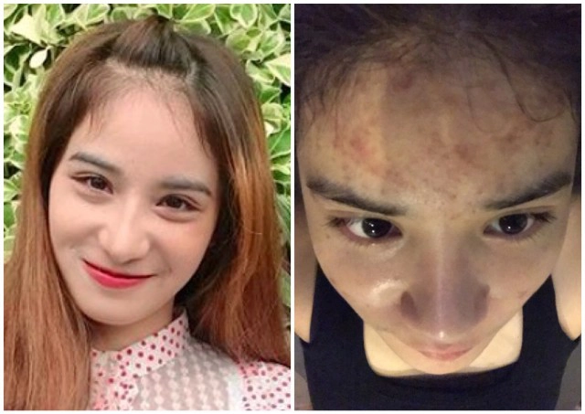 "น้องครีม" เน็ตไอดอล แจ้งความ ปคบ. โวยถูกคลินิกฯชื่อดังใช้สารต้องห้ามผสมเครื่องสำอางจนหน้าพัง!