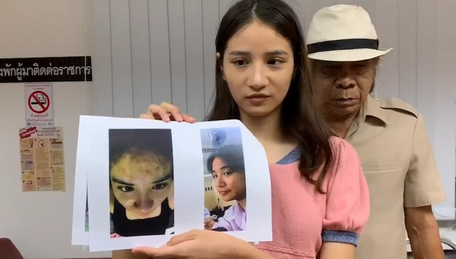 "น้องครีม" เน็ตไอดอล แจ้งความ ปคบ. โวยถูกคลินิกฯชื่อดังใช้สารต้องห้ามผสมเครื่องสำอางจนหน้าพัง!