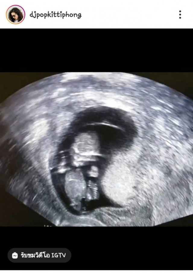 "ดีเจป็อบ" ร่ำไห้กลางรายการหลังเปิดเพลงให้ภรรยาที่เสียลูกคนที่ 2 ในท้อง!