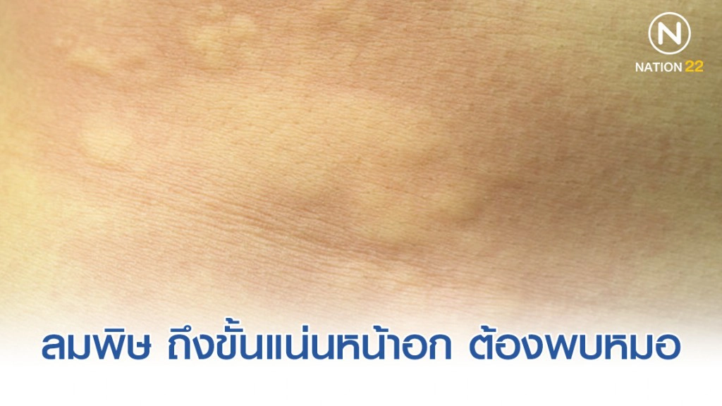 "ลมพิษ" รุนแรงถึงขั้นแน่นหน้าอก ต้องพบแพทย์