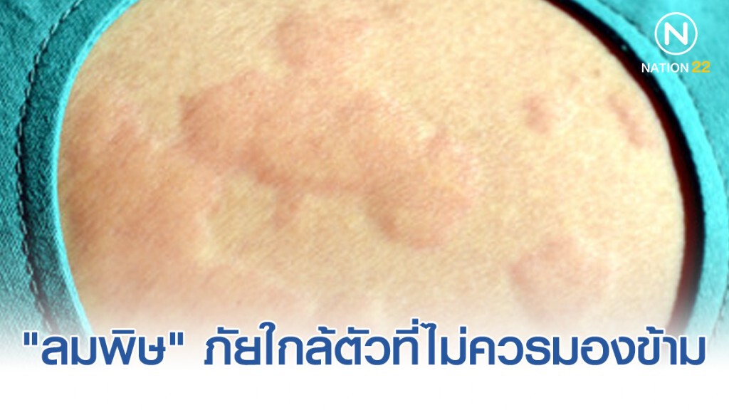 "โรคลมพิษ" ภัยใกล้ตัวที่ไม่ควรมองข้าม "โรคลมพิษ" ภัยใกล้ตัวที่ไม่ควรมองข้าม
