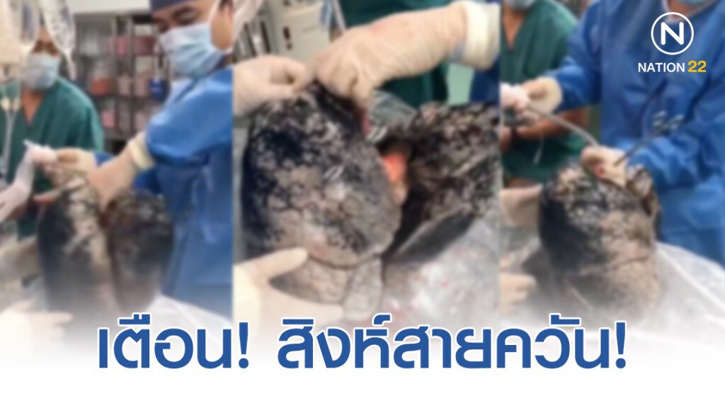 ชาวโซเชียลยกเป็นโฆษณาต้านบุหรี่ดีที่สุด! หมอรับบริจาคไม่ได้ ปอดคน"สูบบุหรี่"วันละซองมานานถึง 30 ปี