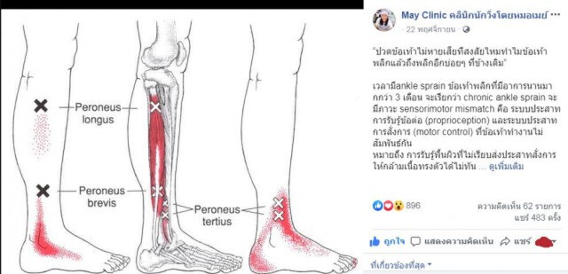 เพจดังเเชร์! เผยสาเหตุปวดข้อเท้าไม่หายเเละข้อเท้าพลิกบ่อยครั้ง