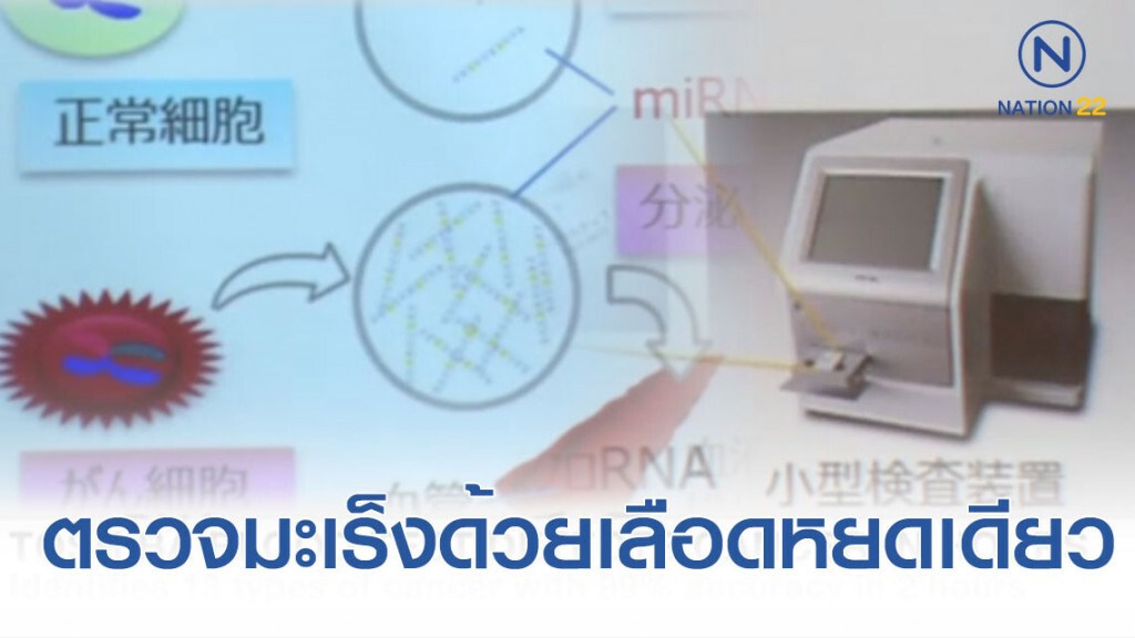 ข่าวดีของวงการแพทย์ ญี่ปุ่นสร้างเครื่องตรวจมะเร็งจากเลือดหยดเดียว