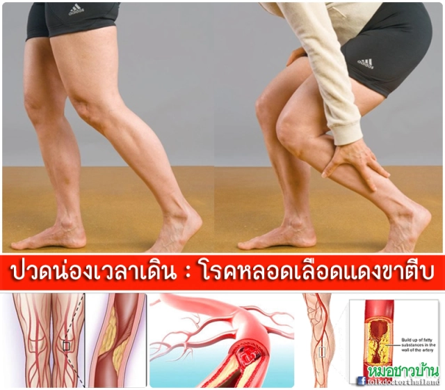 ปวดน่องเวลาเดิน สัญญาณเตือน โรคหลอดเลือดแดงขาตีบ!
