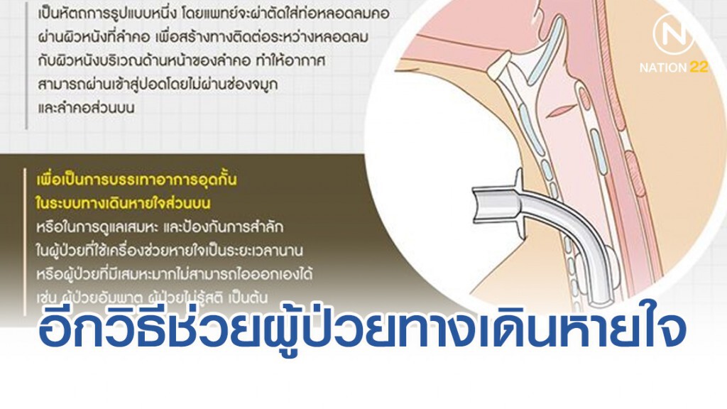 กรมการแพทย์ชี้"เจาะคอ"อีกหนึ่งวิธีการช่วยเหลือผู้ป่วยที่ควรรู้