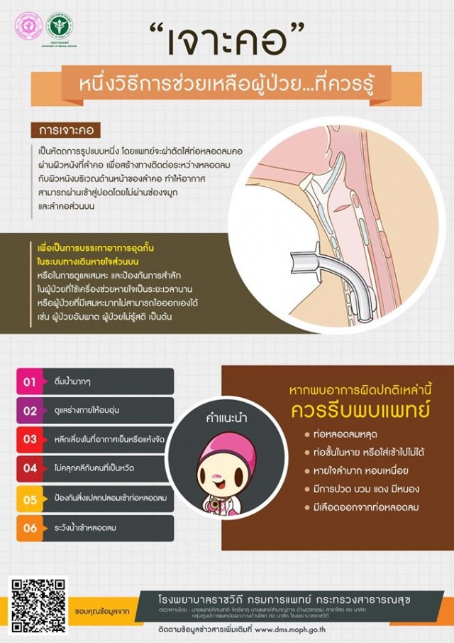 กรมการแพทย์ชี้"เจาะคอ"อีกหนึ่งวิธีการช่วยเหลือผู้ป่วยที่ควรรู้