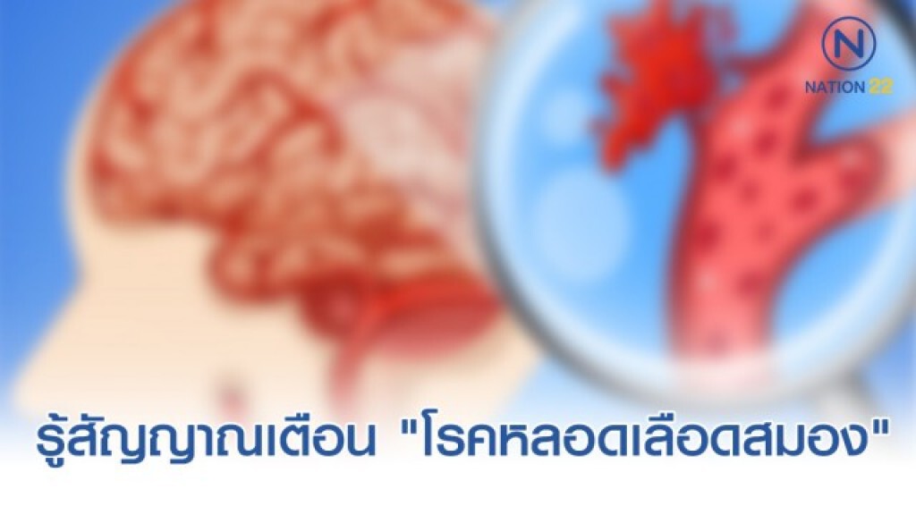 รู้สัญญาณเตือน "โรคหลอดเลือดสมอง" ลดความเสี่ยง "อัมพาต" รู้สัญญาณเตือน "โรคหลอดเลือดสมอง" ลดความเสี่ยง "อัมพาต"