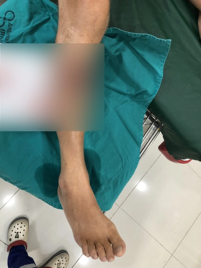 นทท.ถูกฉลามใหญ่กัด ที่หาดนางทอง ขณะเล่นน้ำห่างเพียงฝั่ง7ม.