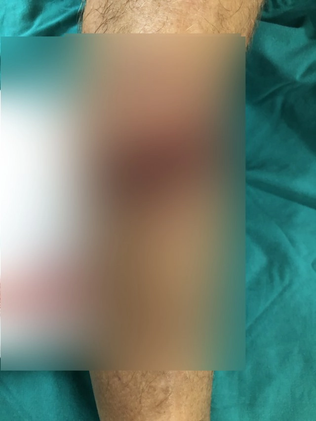 นทท.ถูกฉลามใหญ่กัด ที่หาดนางทอง ขณะเล่นน้ำห่างเพียงฝั่ง7ม.