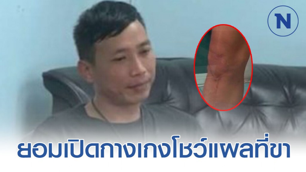 "หลานชายนายกเทศมนตรี" ยัน! ไม่เกี่ยวข้องหลังโดนโยงเป็นโจรปล้นทองลพบุรี พร้อมเปิดกางเกงโชว์แผลที่ขา "หลานชายนายกเทศมนตรี" ยัน! ไม่เกี่ยวข้องหลังโดนโยงเป็นโจรปล้นทองลพบุรี พร้อมเปิดกางเกงโชว์แผลที่ขา