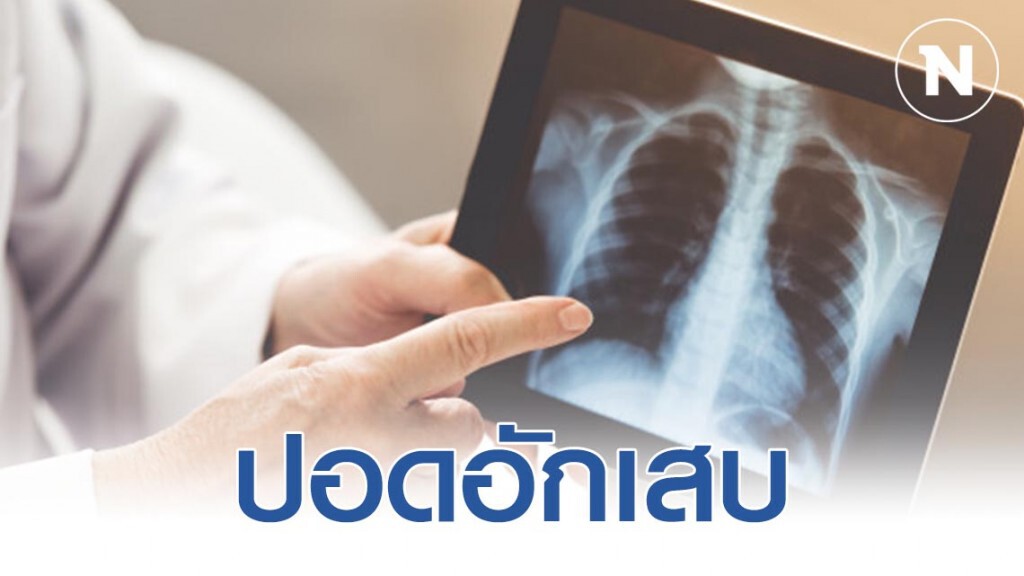 อาการ "ปอดอักเสบ" อย่าปล่อยให้รุนแรง