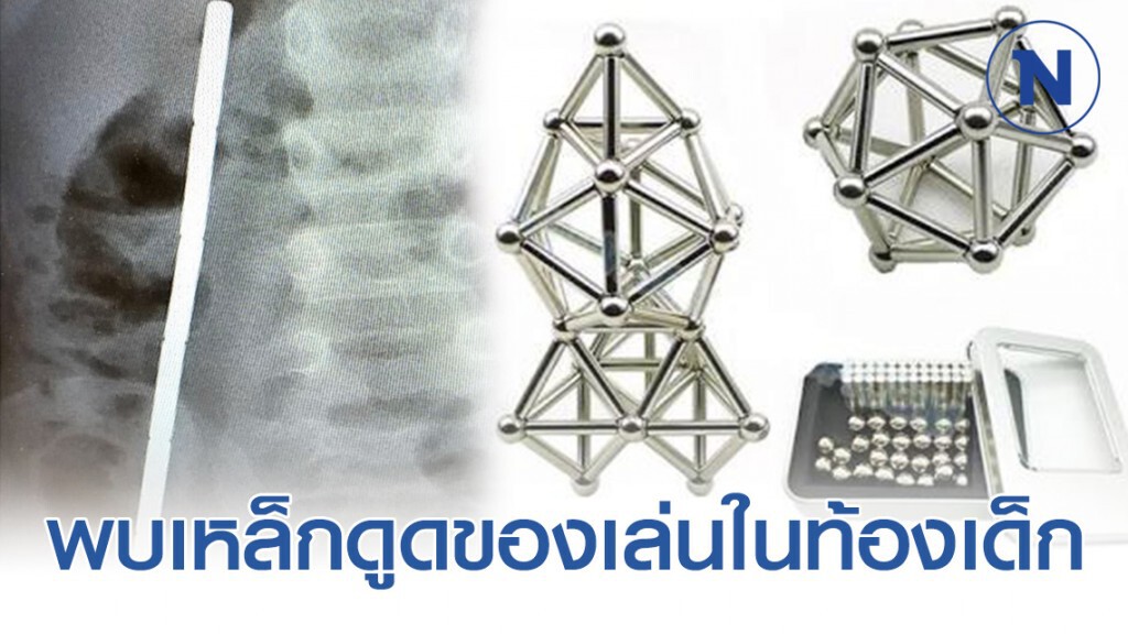 เด็ก6ขวบปวดท้องหนัก ก่อนเอ็กซเรย์พบเหล็กดูดของเล่น 6 ชิ้น ต่อเรียงกันในลำไส้
