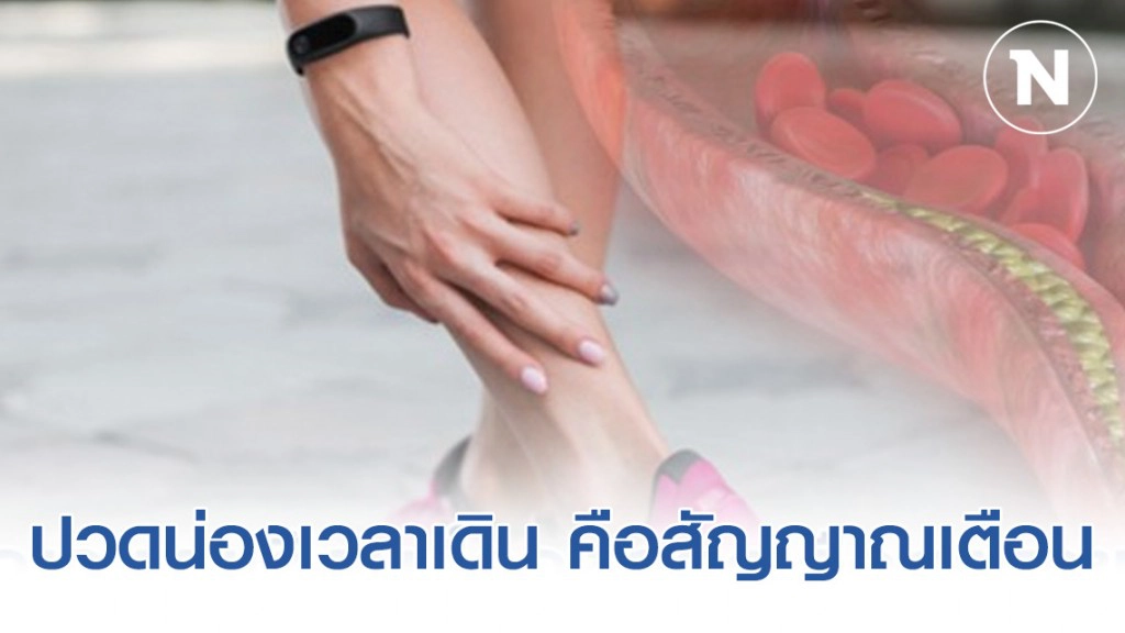 ปวดน่องเวลาเดิน สัญญาณเตือน โรคหลอดเลือดแดงขาตีบ!