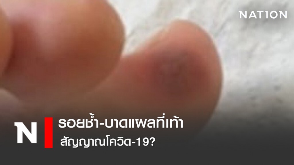 รอยช้ำ-บาดแผลที่เท้าสัญญาณโควิด-19?
