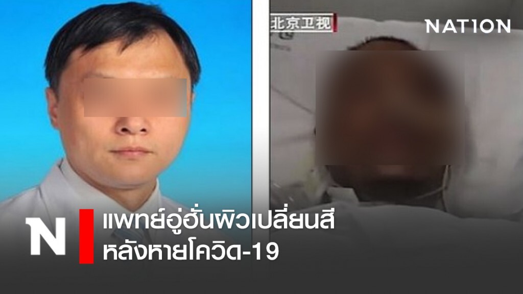 แพทย์อู่ฮั่นผิวเปลี่ยนสีหลังหายโควิด-19
