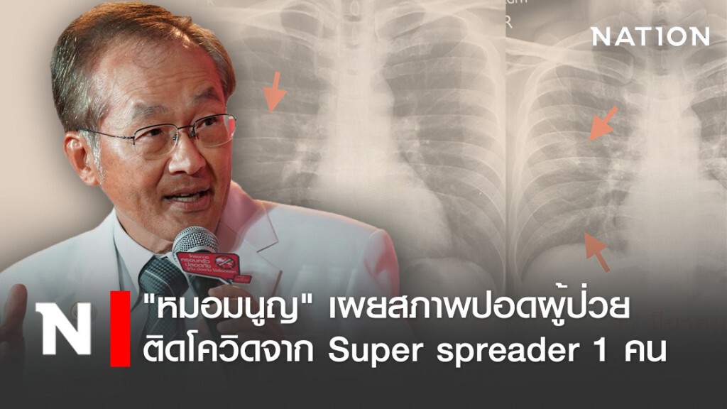 "หมอมนูญ" เผยสภาพปอดผู้ป่วยที่ติดโควิดจาก Super spreader 1 คน