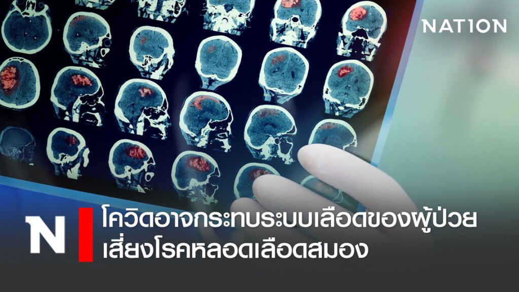 วิจัย ระบุโควิด-19 อาจกระทบระบบเลือดของผู้ป่วย เสี่ยงโรคหลอดเลือดสมอง