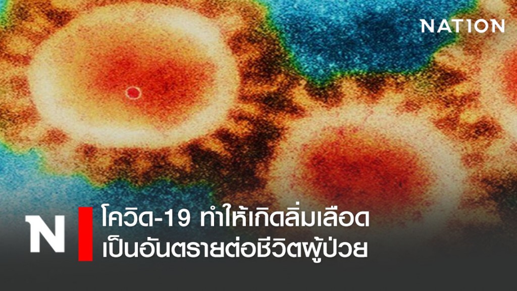 โควิด-19 ทำให้เกิดลิ่มเลือดเป็นอันตรายต่อชีวิตผู้ป่วย โควิด-19 ทำให้เกิดลิ่มเลือดเป็นอันตรายต่อชีวิตผู้ป่วย