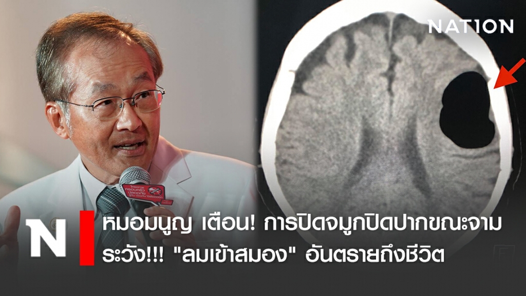หมอมนูญ เตือน! การปิดจมูกปิดปากขณะจาม ระวัง!!! "ลมเข้าสมอง" อันตรายถึงชีวิต