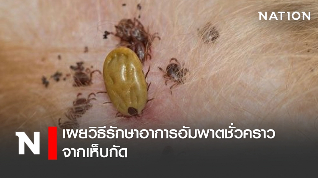 เผยวิธีรักษาอาการอัมพาตชั่วคราว จากเห็บกัด